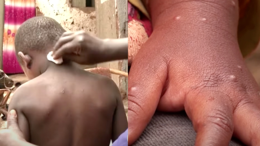 India detects first case of deadlier mpox virus strain in Kerala