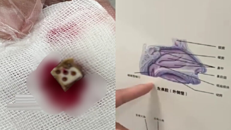 Chinese man relieved of dice stuck in his nose for 20 years