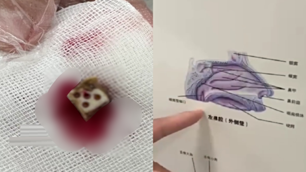 Chinese man relieved of dice stuck in his nose for 20 years