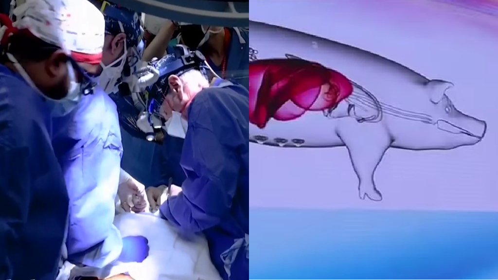 Chinese scientists achieve world’s 1st successful living pig-to-human liver transplant