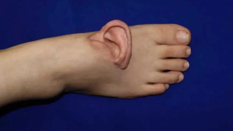 World-first surgery in China preserves severed ear by grafting it onto patient’s foot