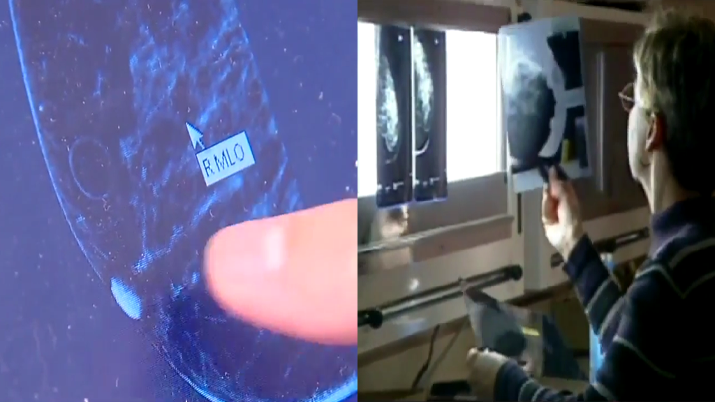 Study ties lifestyle to higher breast cancer survival in Asian American women